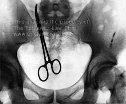X-ray of a retained clamp that the surgical team forgot to remove
