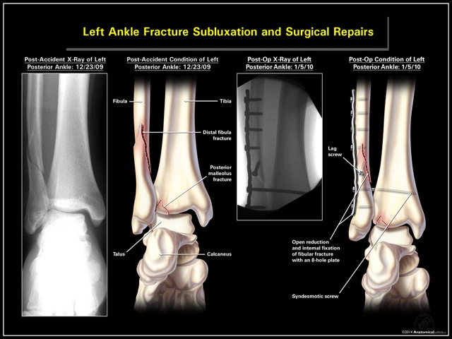 Left Ankle Fracture Subluxation and Surgical Repairs