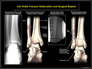 Left Ankle Fracture Subluxation and Surgical Repairs