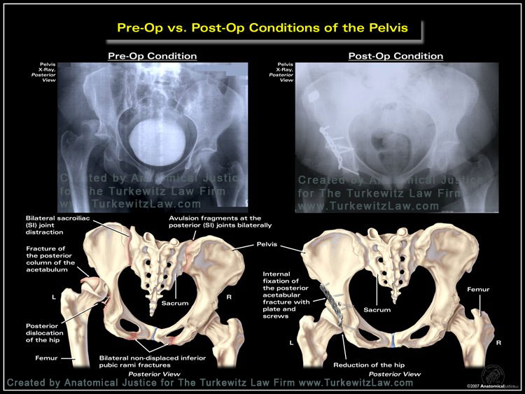 Pre-op vs. Post-op Conditions of the Pelvis