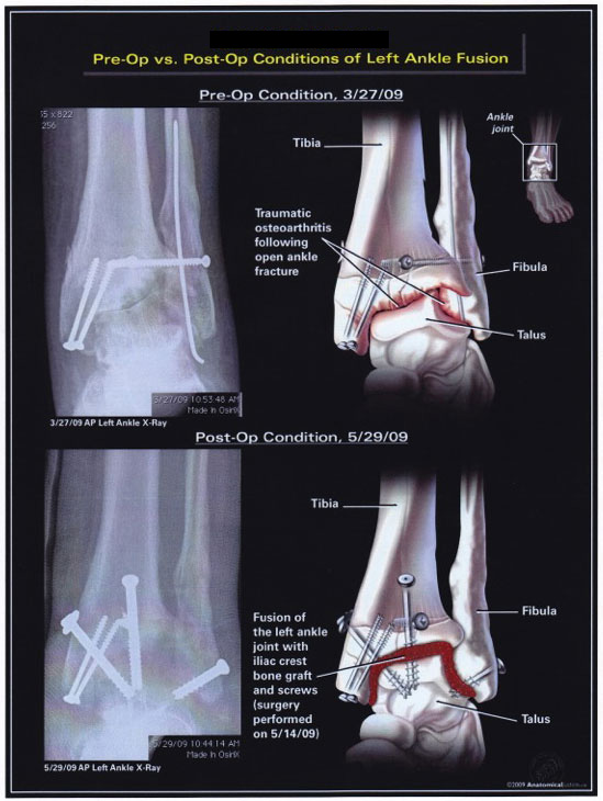 Pre-op vs. Post-op Conditions of Left Ankle Fusion