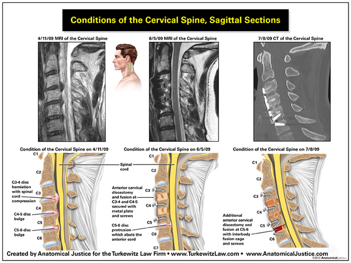 Brooklyn Auto-Bus Collision - herniated discs with neck surgery - broken arm