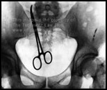 X-ray of a retained clamp that the surgical team forgot to remove