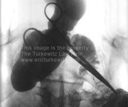 X-ray of a retained clamp that the surgical team forgot to remove.