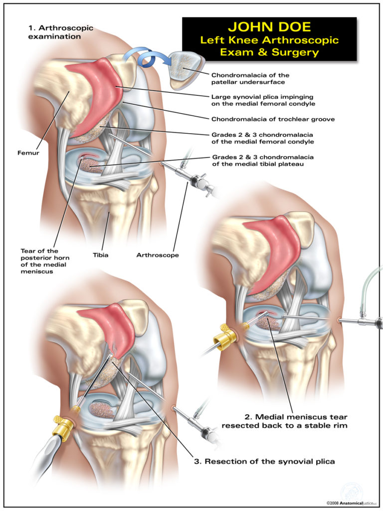 Left Knee Arthroscopic Exam & Surgery