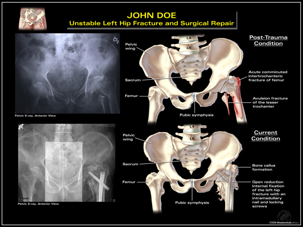 Unstable Left Hip Fracture and Surgical Repair